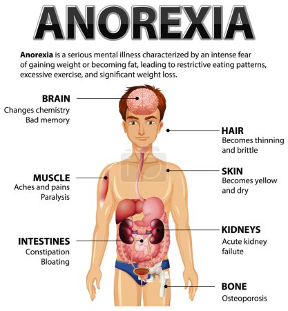 Illustration for Illustration depicting the impact of Anorexia on various body functions - Royalty Free Image