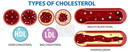 Illustration for Illustration of HDL, LDL, and atherosclerosis in blood vessels - Royalty Free Image