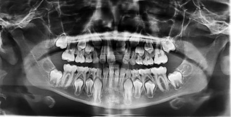 Real capture of an x-ray of the teeth of a 10-year-old child.