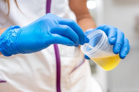 Photo for Close up of Nurse Hand holding urine sample container for medical urine analysis with color strip. High quality photo - Royalty Free Image