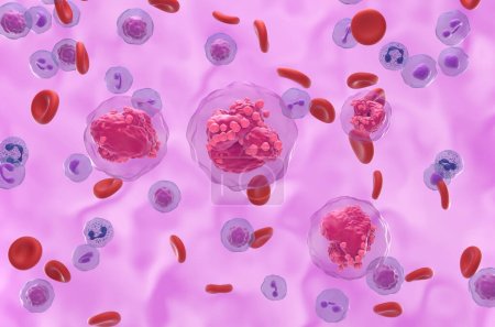 Leucemia linfoblástica aguda (LLA) células cancerosas en el flujo sanguíneo - vista isométrica ilustración 3D
