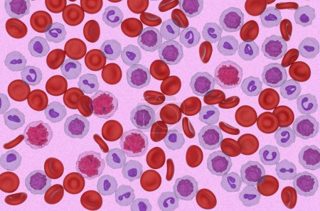 Foto de Leucemia linfoblástica aguda (LLA) células cancerosas en el flujo sanguíneo - vista microscópica ilustración 3D - Imagen libre de derechos