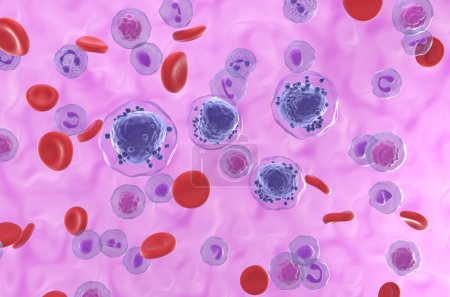 Téléchargez les photos : Leucémie myéloïde aiguë (LMA) dans le flux sanguin - vue isométrique Illustration 3d - en image libre de droit