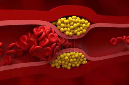 Photo for Fully blocked vessel in high level of LDL (bad cholesterol) lipoprotein  Closeup view 3d illustration - Royalty Free Image