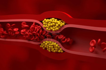 Teilweise blockiertes Gefäß in hohem LDL-Wert (schlechtes Cholesterin) Lipoprotein isometrische Ansicht 3D-Illustration