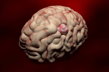 Foto de Tumor de meningioma (cáncer cerebral) en el tejido cerebral - vista isométrica de ilustración 3d - Imagen libre de derechos