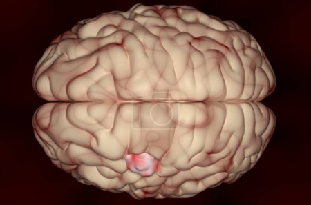 Tumor de meningioma (cáncer cerebral) en el tejido cerebral - vista superior de la ilustración 3d