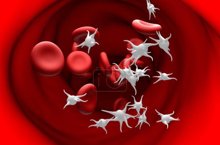 Trombocitemia esencial (ET), sobreproducción de plaquetas (trombocitos) - ver ilustración 3D