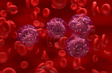 Leucémie lymphoblastique aiguë (LAL) cellules cancéreuses dans le flux sanguin - vue isométrique Illustration 3d