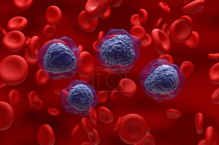 Foto de Células de leucemia mieloide aguda (LMA) en el flujo sanguíneo - vista isométrica ilustración 3D - Imagen libre de derechos