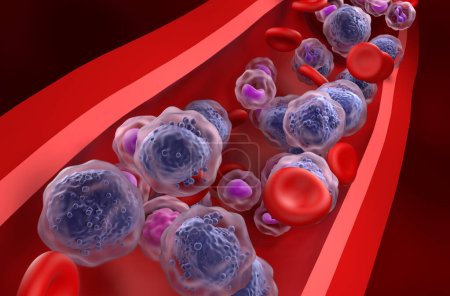 Acute myeloid leukemia (AML) cells in blood flow - closeup view 3d illustration