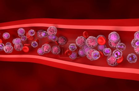 Téléchargez les photos : Leucémie lymphoblastique aiguë (LAL) cellules cancéreuses dans le flux sanguin - vue isométrique Illustration 3d - en image libre de droit
