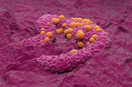 Foto de Carcinoma de células basales (CCB) - vista isométrica ilustración 3D - Imagen libre de derechos