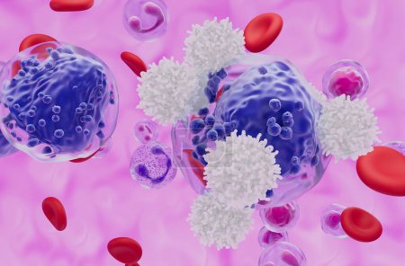 Foto de Glóbulos blancos con células de leucemia mieloide aguda (LMA) - vista de cerca ilustración 3d - Imagen libre de derechos