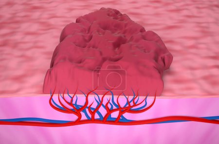 Téléchargez les photos : Tumeur de l'hémangiome - illustration 3D vue du haut - en image libre de droit