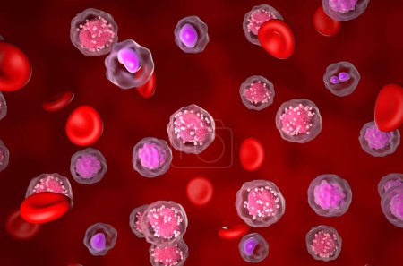 Téléchargez les photos : Leucémie aiguë lymphocytaire (LAL) - vue isométrique Illustration 3D - en image libre de droit