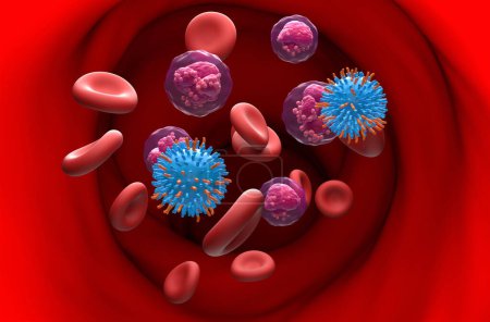 Foto de Terapia con células T CAR en la leucemia linfocítica aguda (LLA) - ver ilustración en 3D - Imagen libre de derechos
