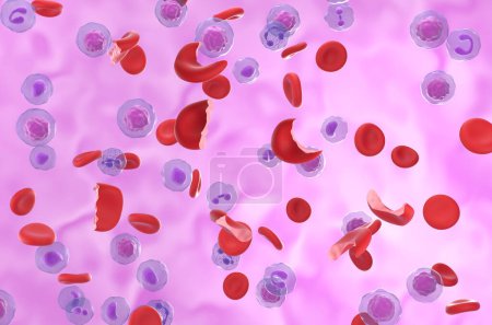 Téléchargez les photos : Cellules de l'anémie hémolytique (HA) dans le flux sanguin - vue isométrique Illustration 3d - en image libre de droit