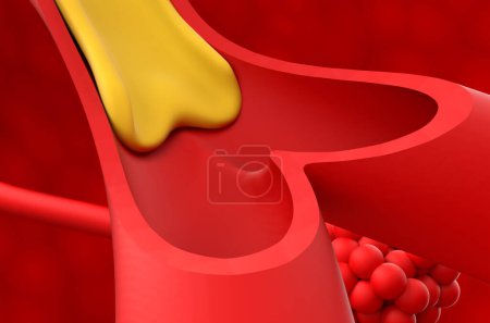 Cystic fibrosis (CF) - Closeup view 3d illustration