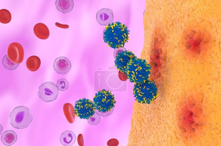 CAR T cell therapy in Rheumatoid arthritis - isometric view 3d illustration