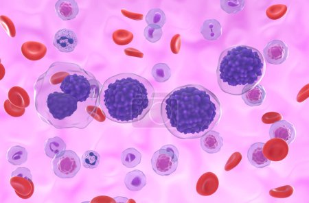 Leucemia de células plasmáticas (LCP) - vista isométrica ilustración 3D