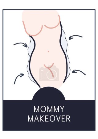 Icono de cirugía cosmética de cambio de imagen de mamá, arte de línea de procedimiento de lipoescultura, clínica de cirujano plástico, ilustración de cirugía cosmética de liposucción de abdomen Tuck 