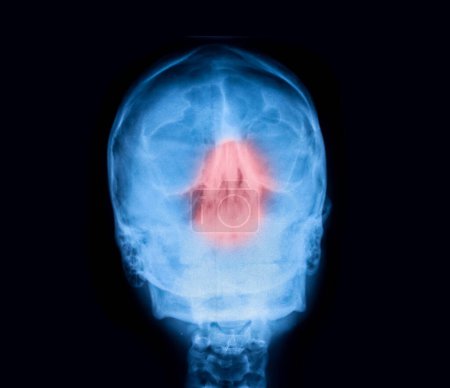 Téléchargez les photos : Radiography x-ray film of human skull and paranasal sinuses - en image libre de droit