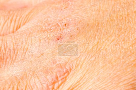 Photo for Close Up of woman hand with very dry skin and deep cracks - Royalty Free Image