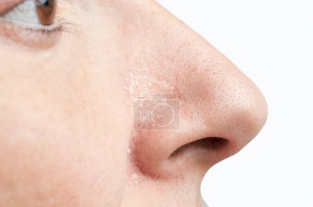 Photo for Woman with atopic dermatitis symptom on her nose - Royalty Free Image