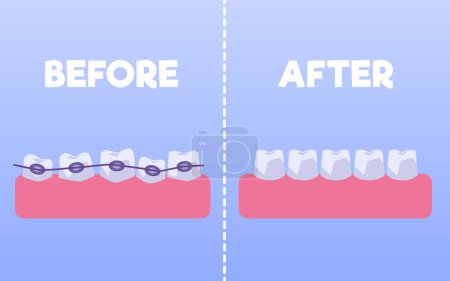 Ilustración de Dientes antes y después frenos estilo plano, ilustración vectorial aislado sobre fondo azul. Alineación de la mordedura de los dientes, dentición con frenos, comparación, tratamiento ortodóncico - Imagen libre de derechos