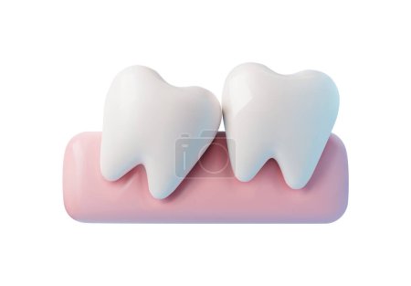 Illustration for 3D teeth grow incorrectly, tooth wrong tilted. Wisdom tooth eruption problems, inflamed gums. Vector realistic jaws dental anatomy illustration isolated on white. Orthodontic and dentistry 3d concept - Royalty Free Image