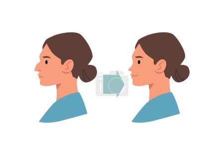 Illustration for Correction plastic surgery, nose reshaping. Before After rhinoplasty. Woman with a big crooked nose and happy lady beautiful little nose. Facial reduction vector infographic illustration - Royalty Free Image