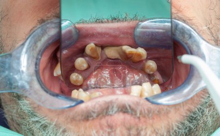 Téléchargez les photos : Dents pourries lors de l'inspection avec rétracteur pour la conception d'implant dentaire. - en image libre de droit