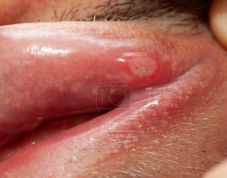 Téléchargez les photos : L'homme montre sa lèvre inférieure de la bouche avec aphtha
. - en image libre de droit