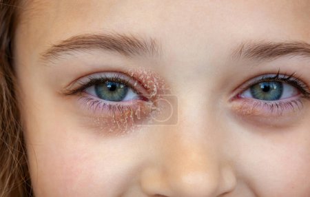 Ojo de una niña que sufre de dermatitis atópica ocular o eccema de párpado. Expresión serena y sonriente.