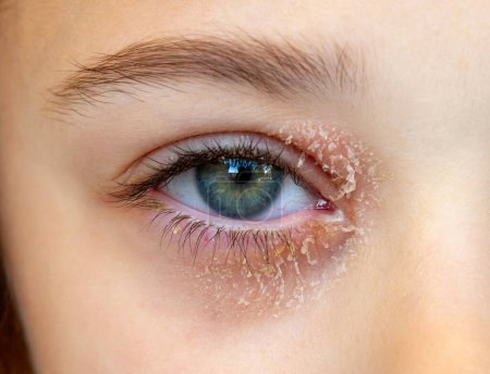 Auge eines kleinen Mädchens, das an okulärer atopischer Dermatitis oder Augenliderekzemen leidet.
