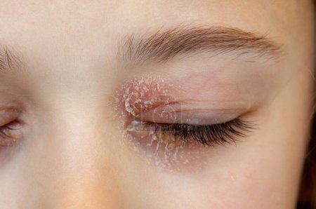 Foto de Ojo cerrado de una niña que sufre de dermatitis ocular atópica o eccema de párpado. - Imagen libre de derechos