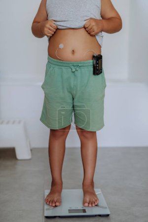 Foto de Un niño con diabetes que se pesa en la balanza del baño. Necesidad de control de peso en pacientes diabéticos pediátricos. Niño usando monitor continuo de glucosa. - Imagen libre de derechos
