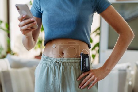 Close up of diabetic woman with insulin pump. Young woman with type 1 diabetes at home.