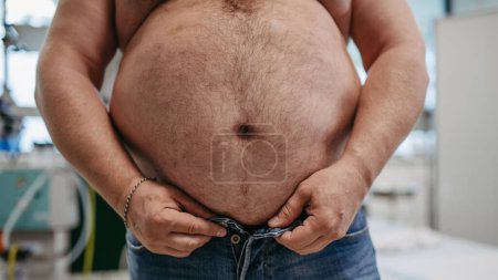 Téléchargez les photos : Gros plan de l'abdomen du patient en surpoids. Tour de taille haute de l'homme obèse. Concept des risques pour la santé liés à la surcharge pondérale et à l'obésité. - en image libre de droit