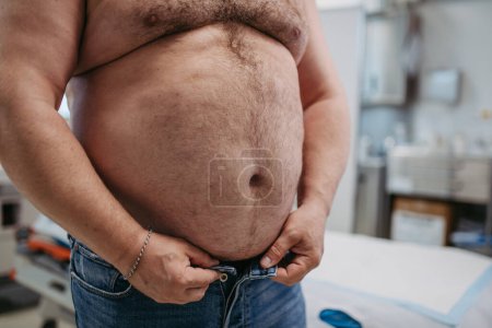 Téléchargez les photos : Gros plan de l'abdomen du patient en surpoids. Tour de taille haute de l'homme obèse. Concept des risques pour la santé liés à la surcharge pondérale et à l'obésité. - en image libre de droit