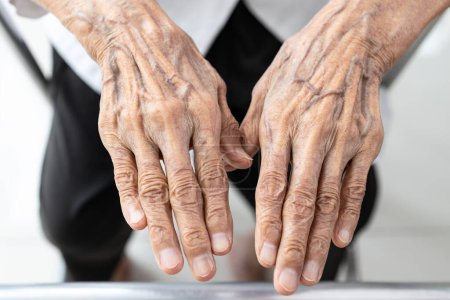 Photo for Old elderly woman showing wrinkled hands and bulging vein on the back of hands,veins more prominent,skin changes,problems of skin and tissues may become thinner and lose elasticity,veins to bulge - Royalty Free Image