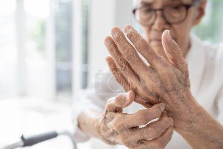 Photo for Old elderly scratch her hands,dry skin (Xerosis),Dermatitis problems,itchy skin on the back of hands,contact with irritants or allergens,allergies to certain soaps, detergents,itching and discomfort - Royalty Free Image