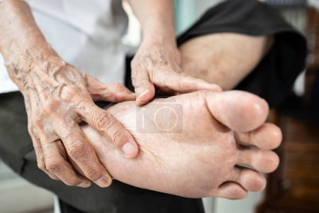 Téléchargez les photos : Les maladies de l'arthrose ou de la polyarthrite rhumatoïde peuvent affecter les articulations et les douleurs aux pieds, la neuropathie périphérique, les picotements ou engourdissements de la semelle et du talon, ou la métatarsalgie, inflammation de la boule du pied - en image libre de droit