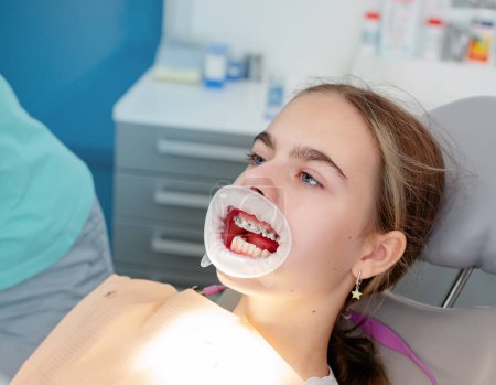 Concept of dental care. Enlarged image of ceramic and metal braces on teeth. Close-up view of dentist's hands applying blue glue to patient's clean bottom teeth before attaching braces