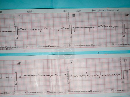 Téléchargez les photos : Un électrocardiogramme ou une image ecg décrivant une anomalie du rythme cardiaque, à savoir une fibrillation auriculaire ou un flutter auriculaire - en image libre de droit