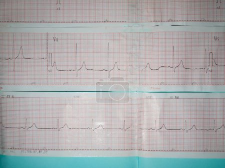 Photo for An electrocardiogram or ecg picture that describes a heart rhythm abnormality, namely left ventricle hypertrophy or high voltage - Royalty Free Image