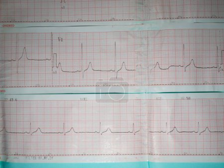 Téléchargez les photos : Un électrocardiogramme ou une image ecg décrivant une anomalie du rythme cardiaque, à savoir une hypertrophie ventriculaire gauche - en image libre de droit