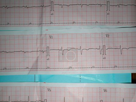 Photo for An electrocardiogram or ecg picture that describes a heart rhythm abnormality, namely incomplete right bundle branch block or incomplete rbbb - Royalty Free Image