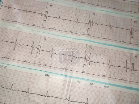 Téléchargez les photos : Un électrocardiogramme ou une image ecg qui décrit une anomalie du rythme cardiaque à savoir une onde t inversée sur l'antéroseptal qui indique habituellement une ischémie sur le myocard - en image libre de droit